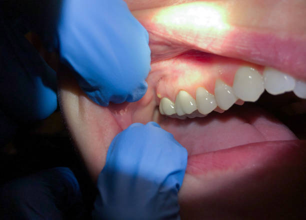 Best Dentist for Tooth Abscess  in Astor, FL
